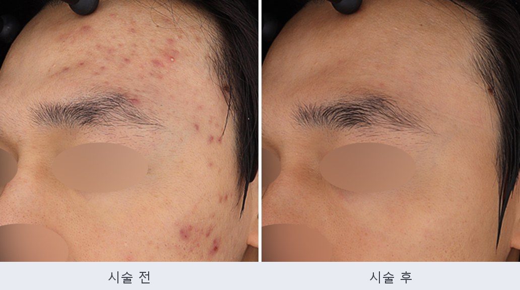 여드름 붉은자국