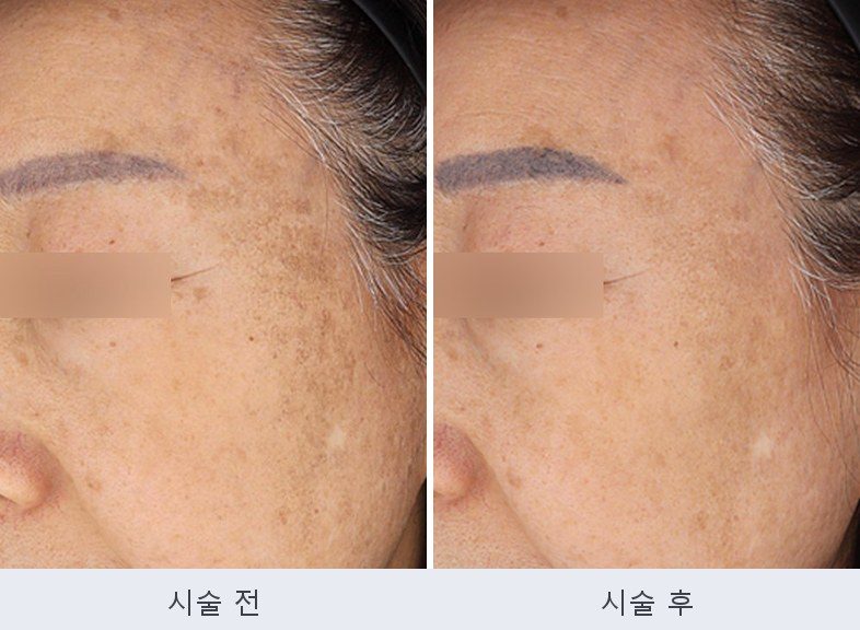 기미 주근깨 흑자